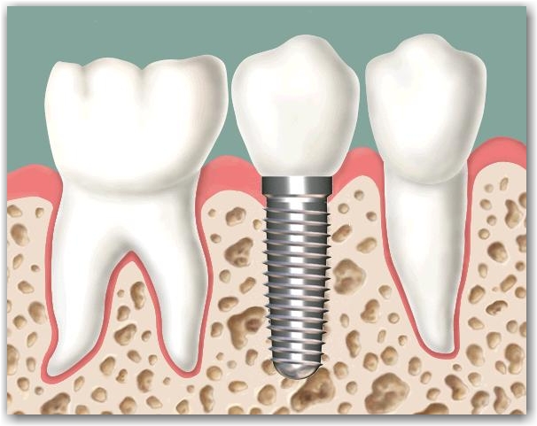 Thời gian cấy ghép implant tiêu chuẩn mất bao lâu